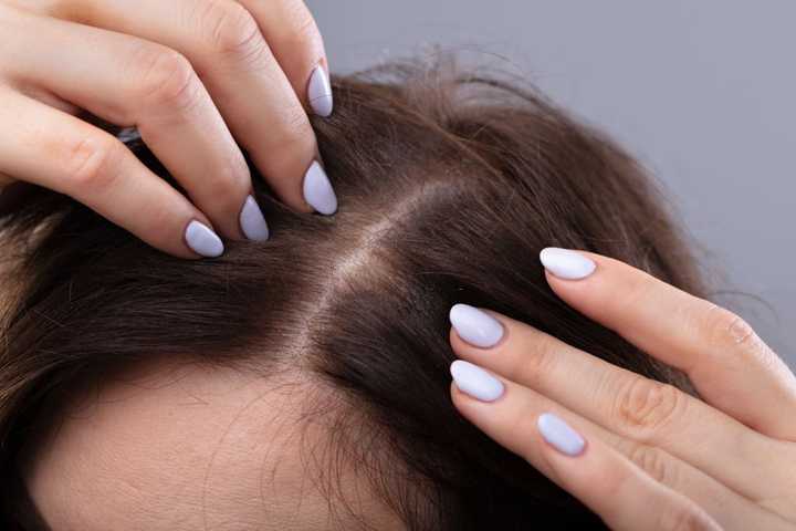 Flutamide for hair loss