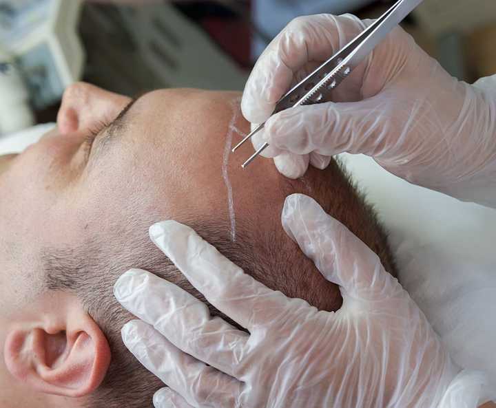 Hair transplant surgery