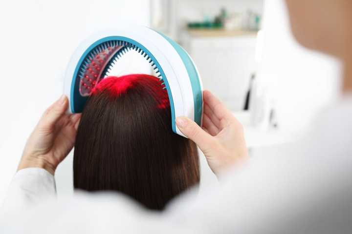 Laser Therapy for female hairloss