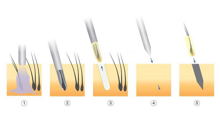 Pros and Cons of FUE Hair Surgery