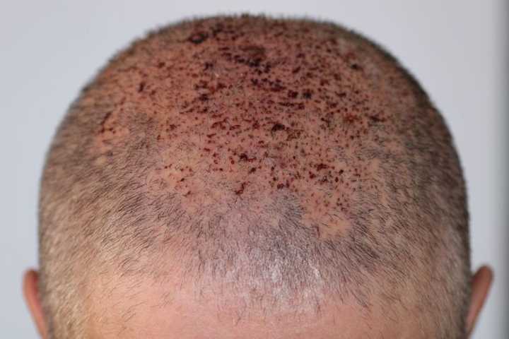 follicular units of transplanted hair 