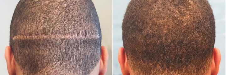 No scarring claimed by the FUE method