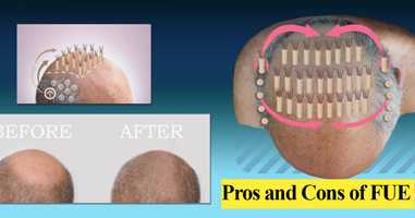 Pros and Cons of FUE Hair Surgery