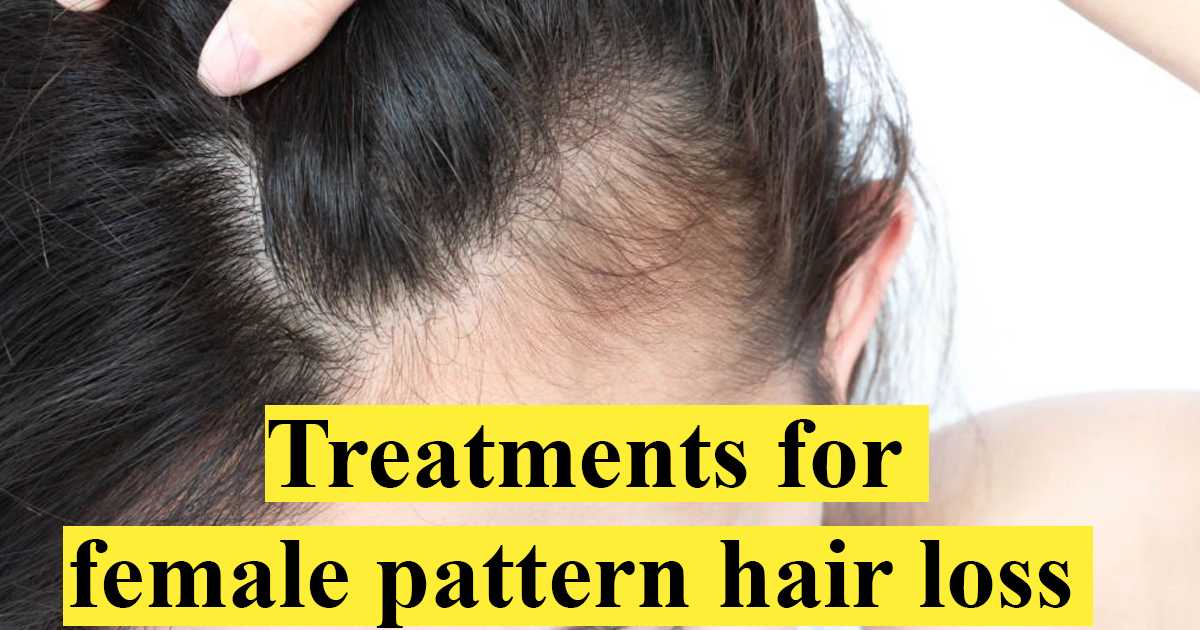 Treatments for female pattern hair loss
