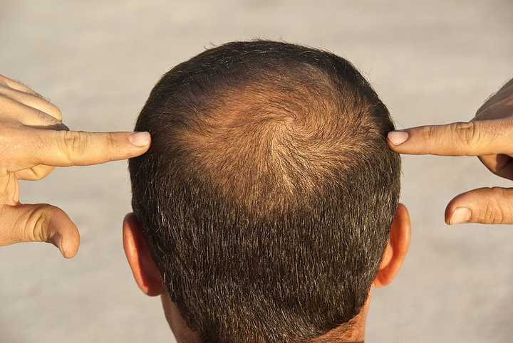 Dutasteride for Male Pattern Hair Loss