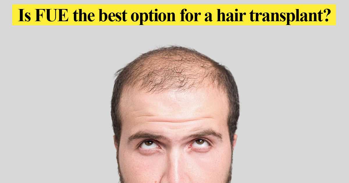 Is FUE the best option for a hair transplant?