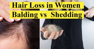 Hair Loss in Women (Shedding vs Balding)