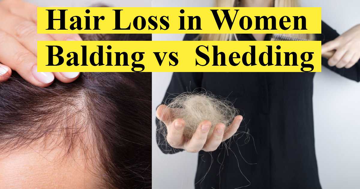 Hair Loss in Women (Shedding vs Balding)