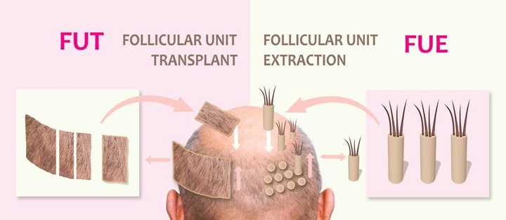 Is FUE the best option for a hair transplant?