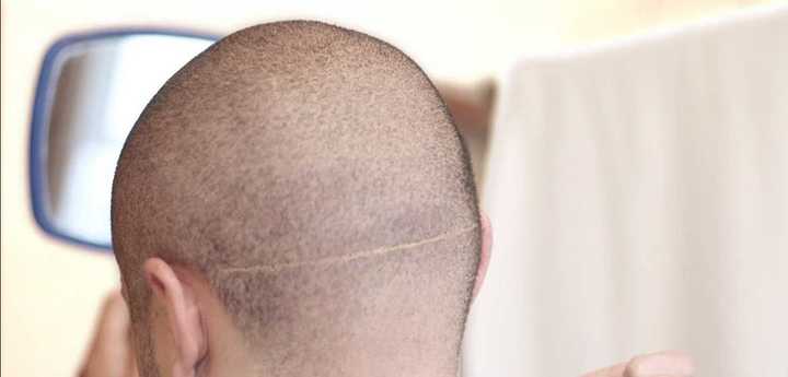 Problems with the hair transplant